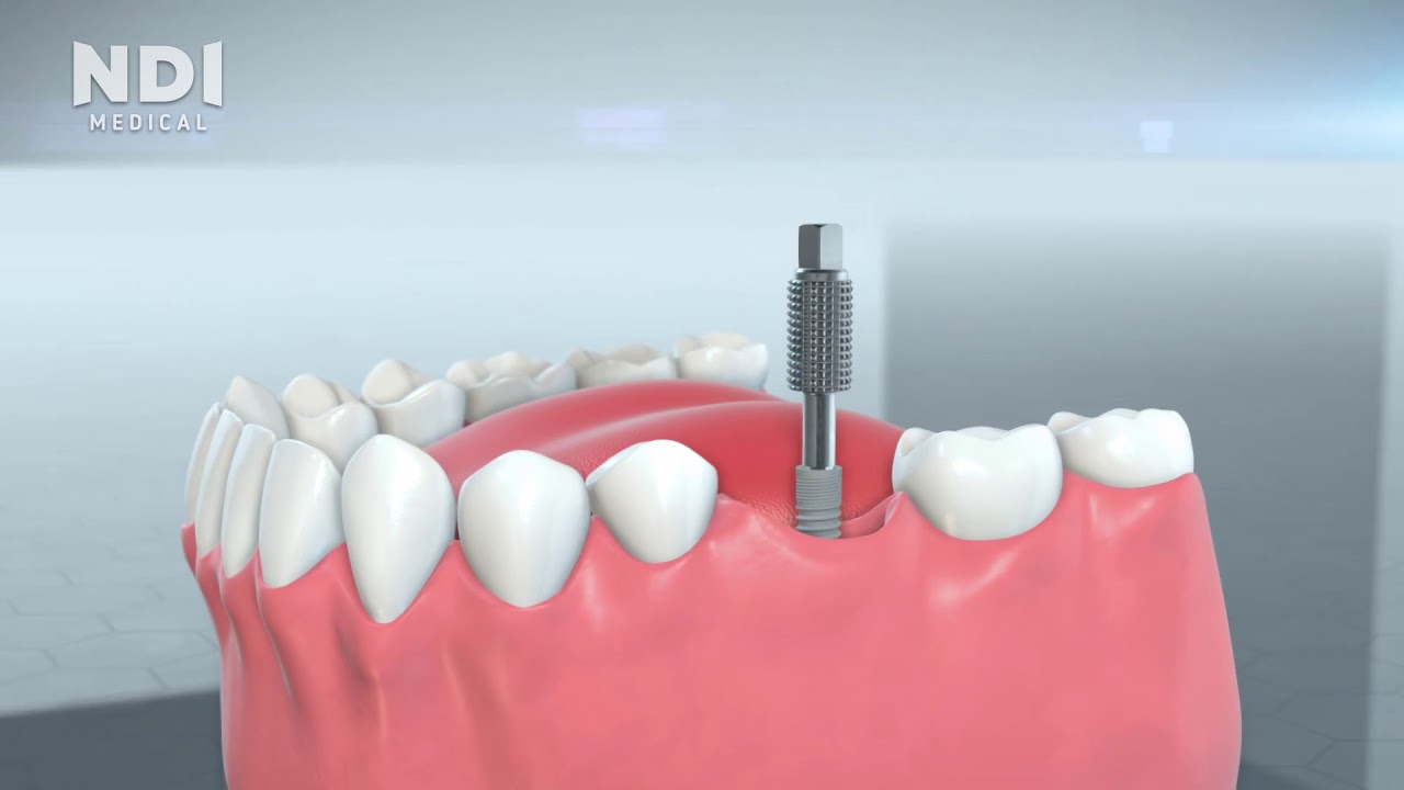German dental implant manufacturers